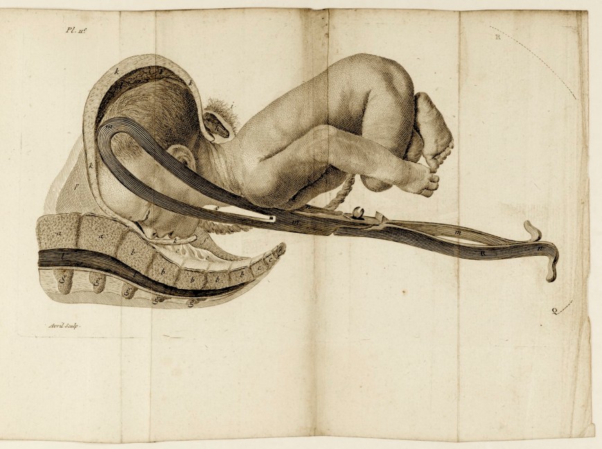 L0050180 Plate showing the birth of a baby, using forceps (3 of 4)